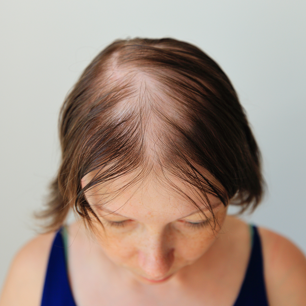 Haarausfall bei Frauen Frau mit Haarausfall