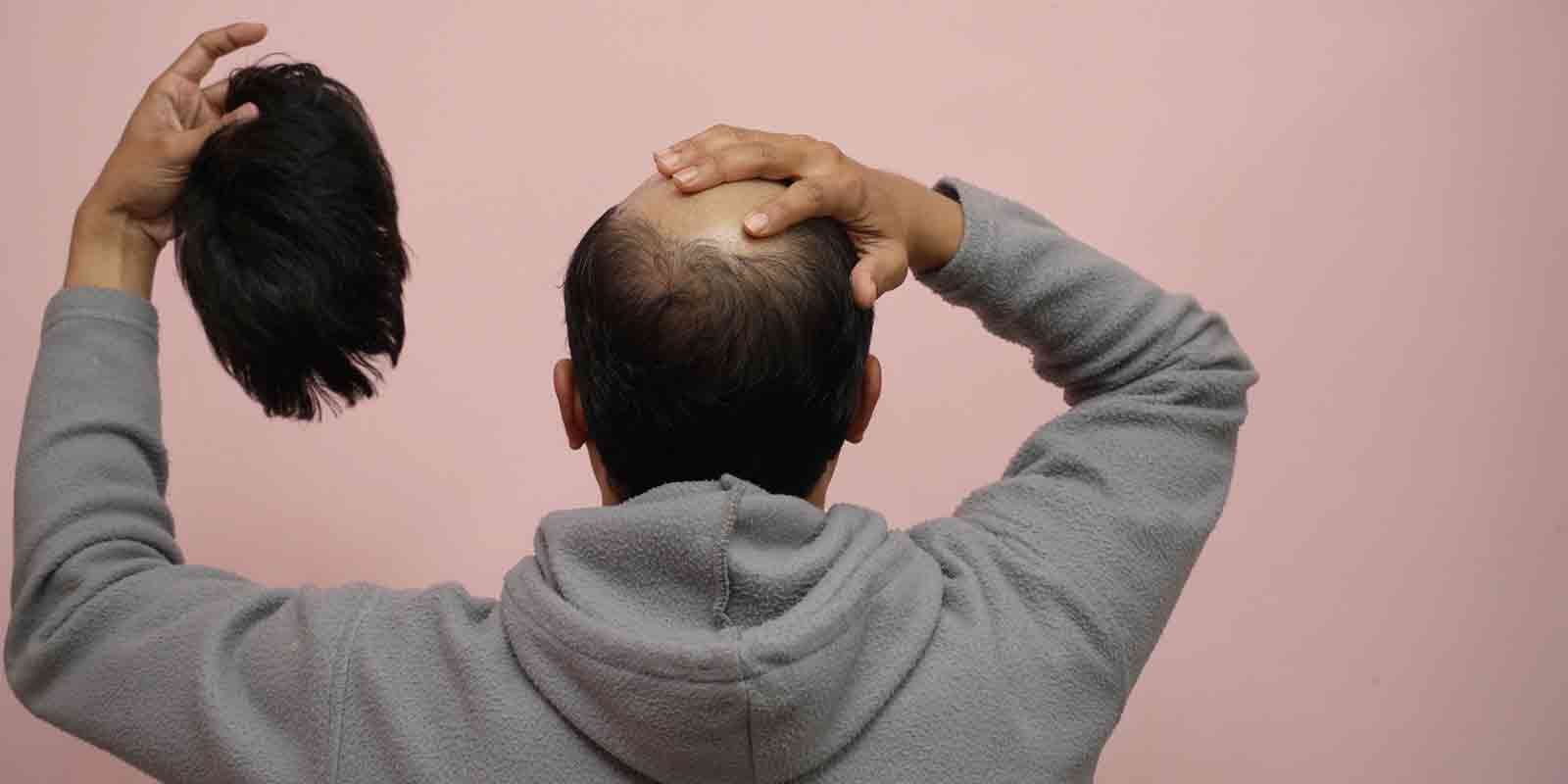 Mann mit Haarausfall hat ein Toupet in der Hand